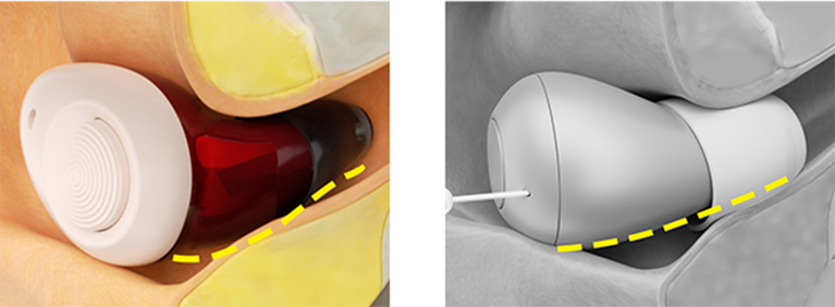 Torch (in ear)