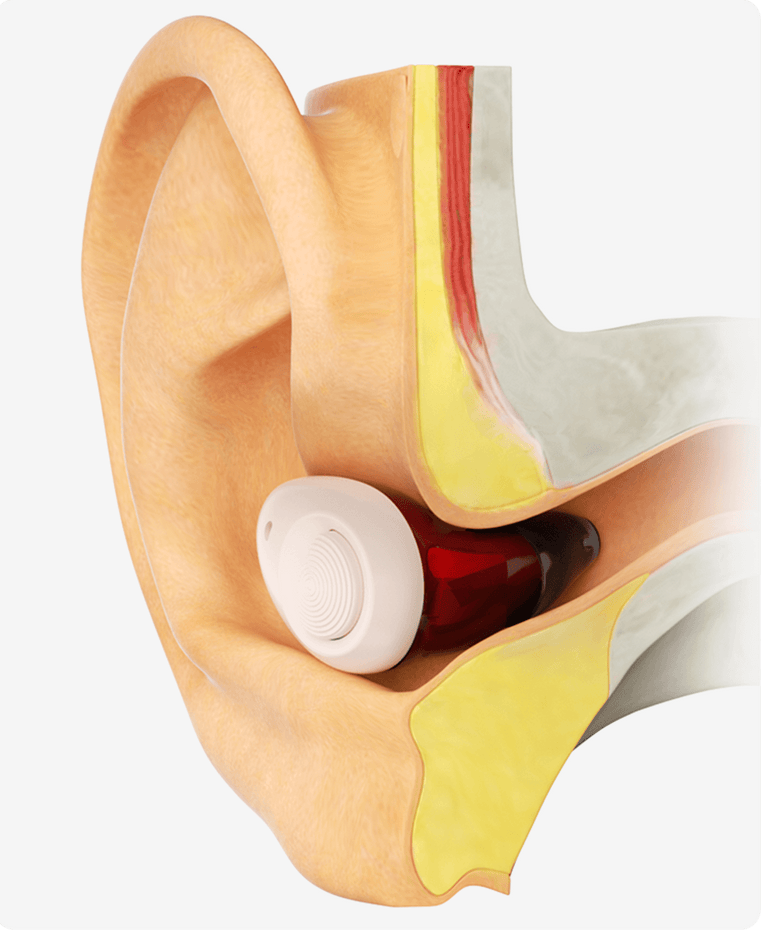 Torch (in ear)